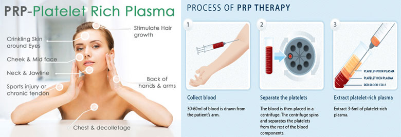 PRP Injections