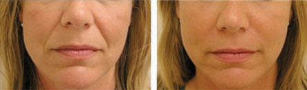 Juvederm