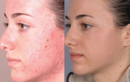 Microdermabrasion